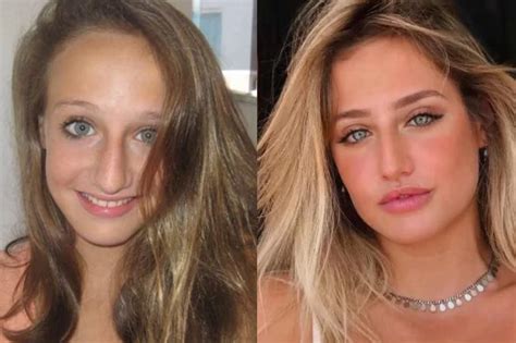 bruna griphao antes da cirurgia|BRUNA DO BBB 23 ANTES E DEPOIS: Saiba。